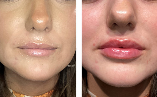 Dermal Filler Ashland KY - Before & After Lower Face and Lip Treatment